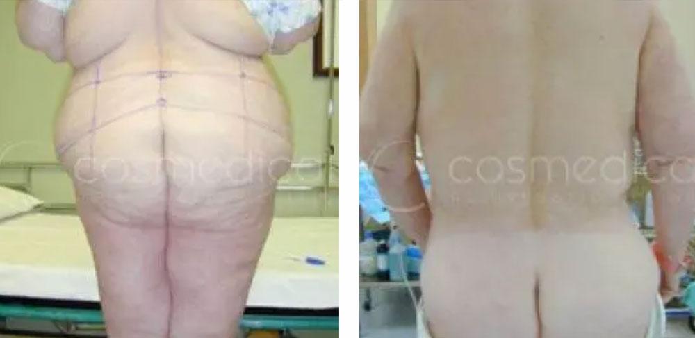 before after after weight loss body contouring