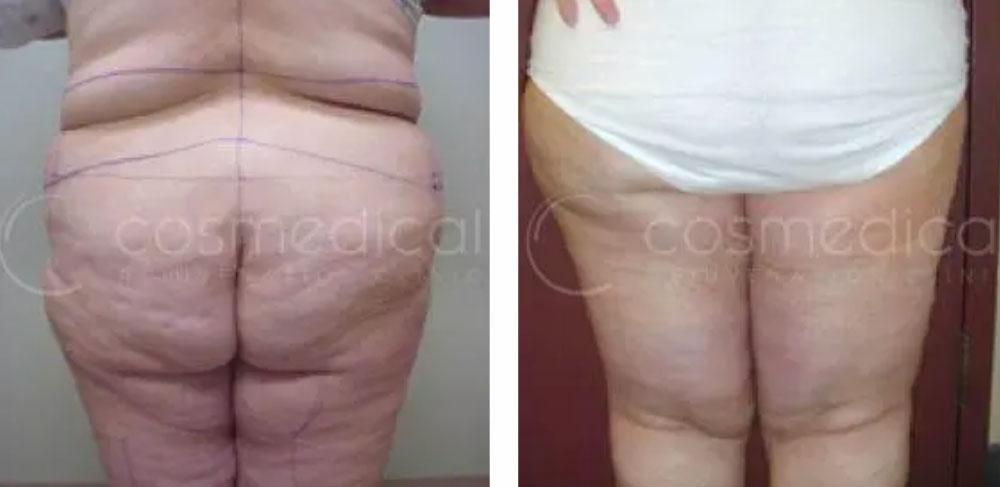 before after after weight loss body contouring