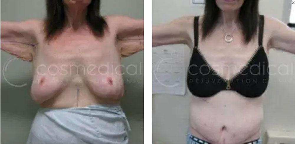 before after armlift