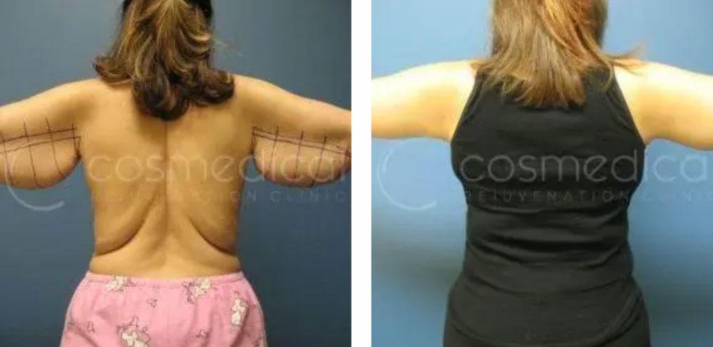 before after armlift