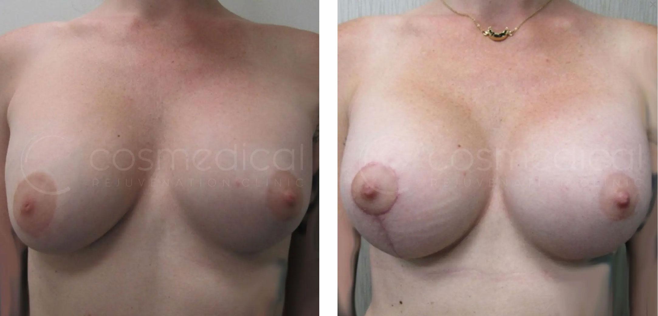 before after breast asymmetry correction