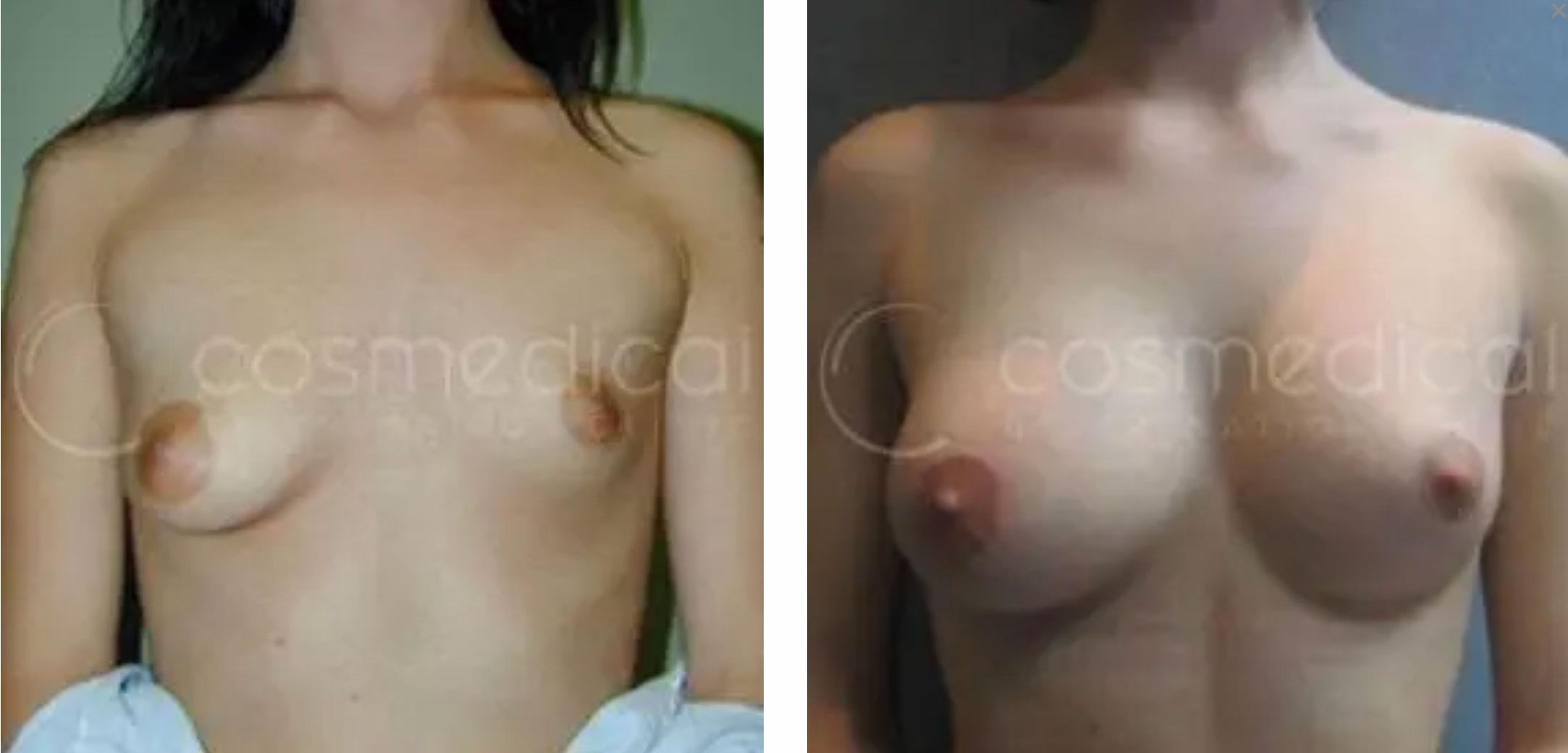 before after breast asymmetry correction