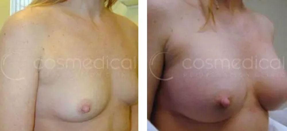 before after breast augmentation before and after