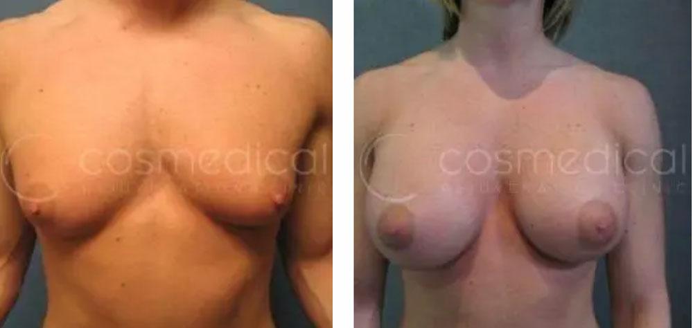 before after breast augmentation before and after