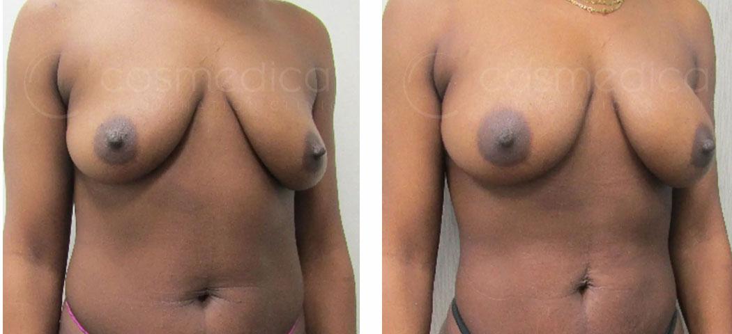 fat transfer breast augmentation before and after
