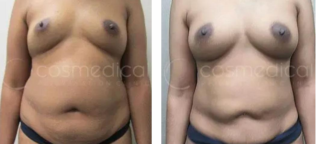 fat transfer breast augmentation before and after