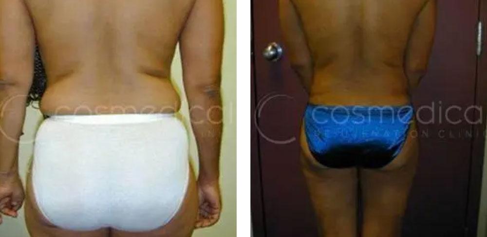 liposuction before and after