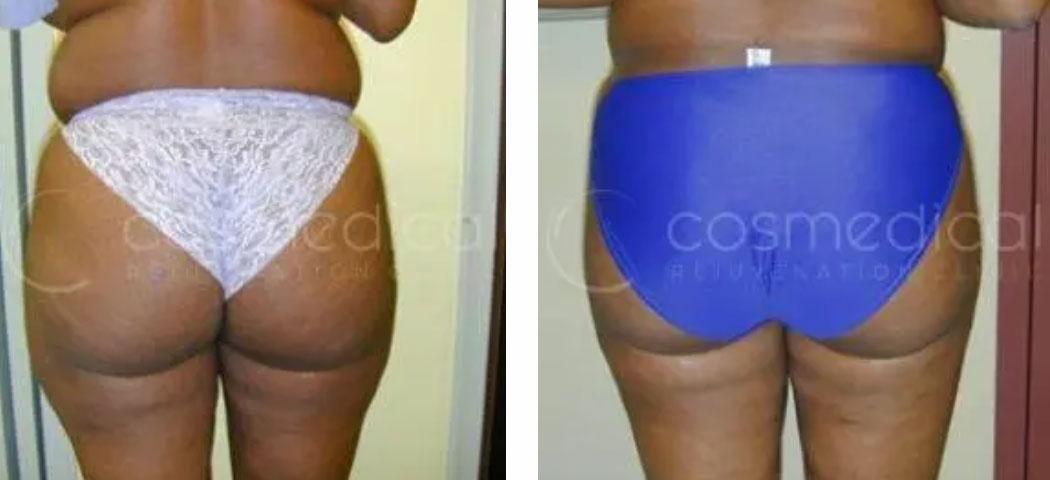 liposuction before and after