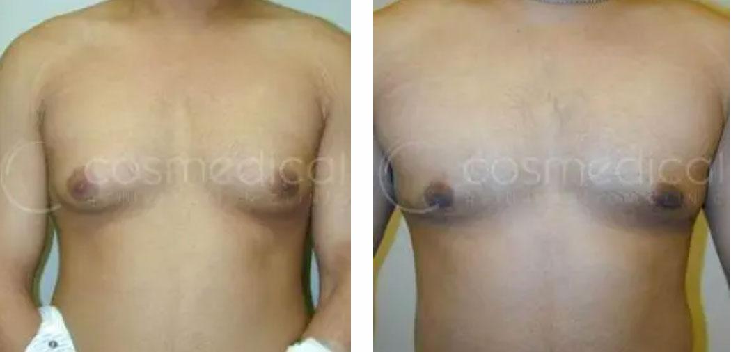 male breast reduction before and after
