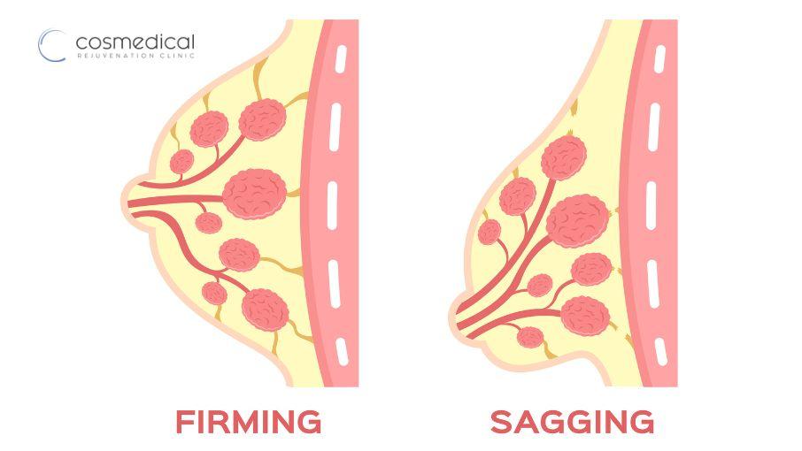 breast sagging diagram