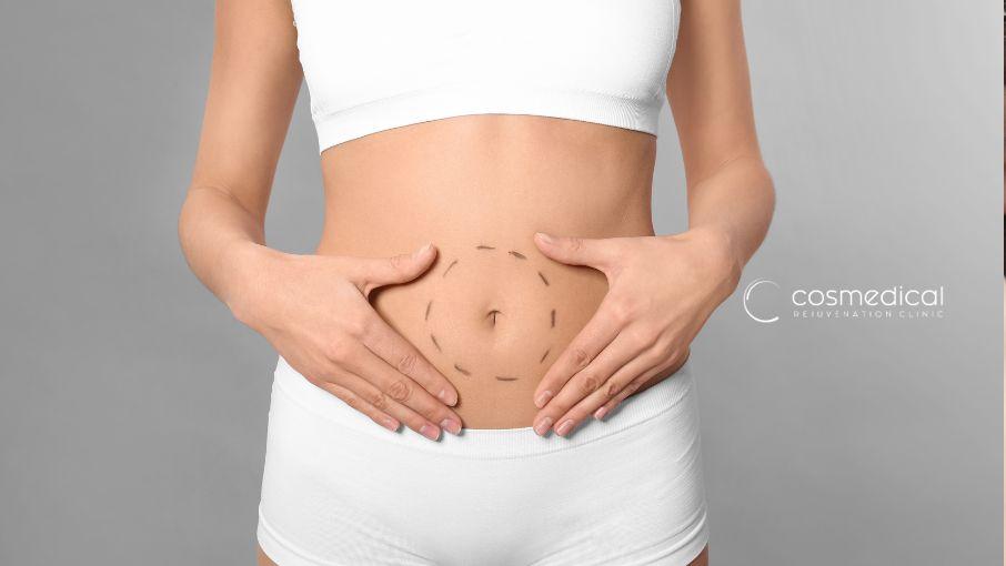 woman showing stomach after tummy tuck