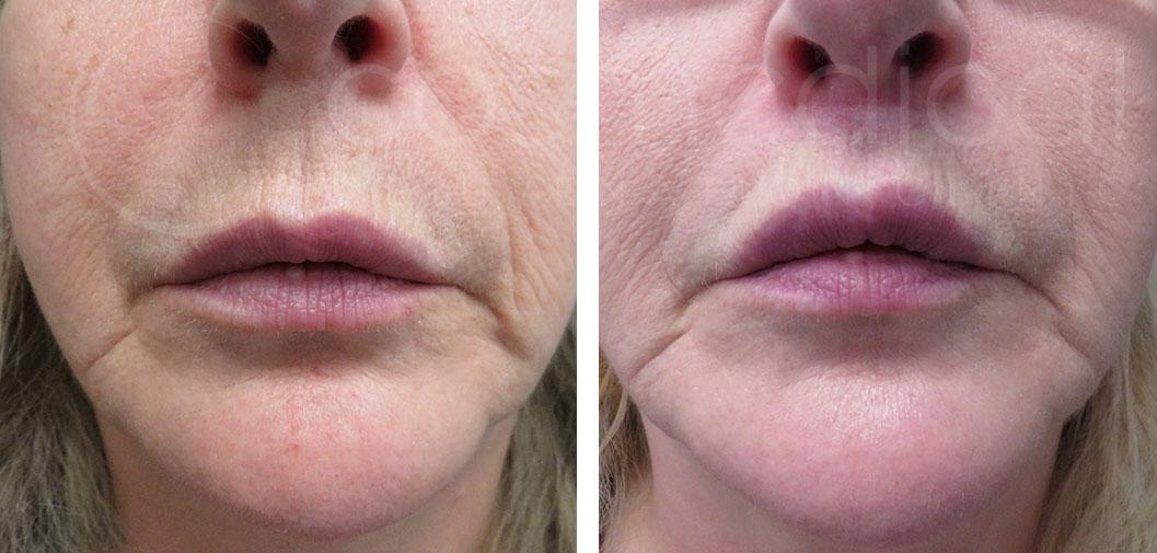 lip lift before and after 