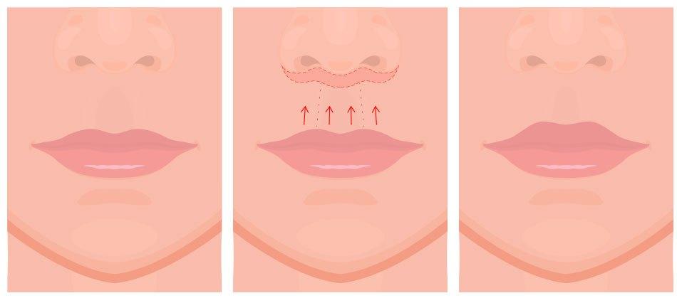 lip lift diagram