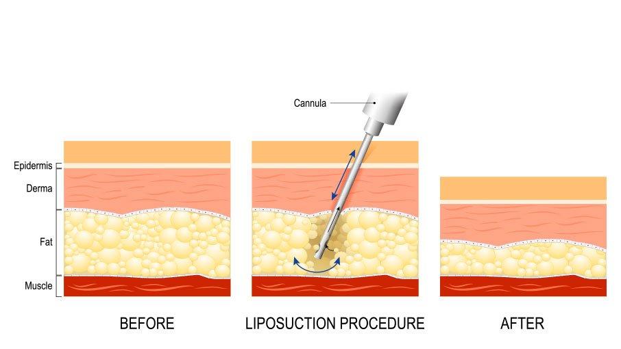 liposuction diagram