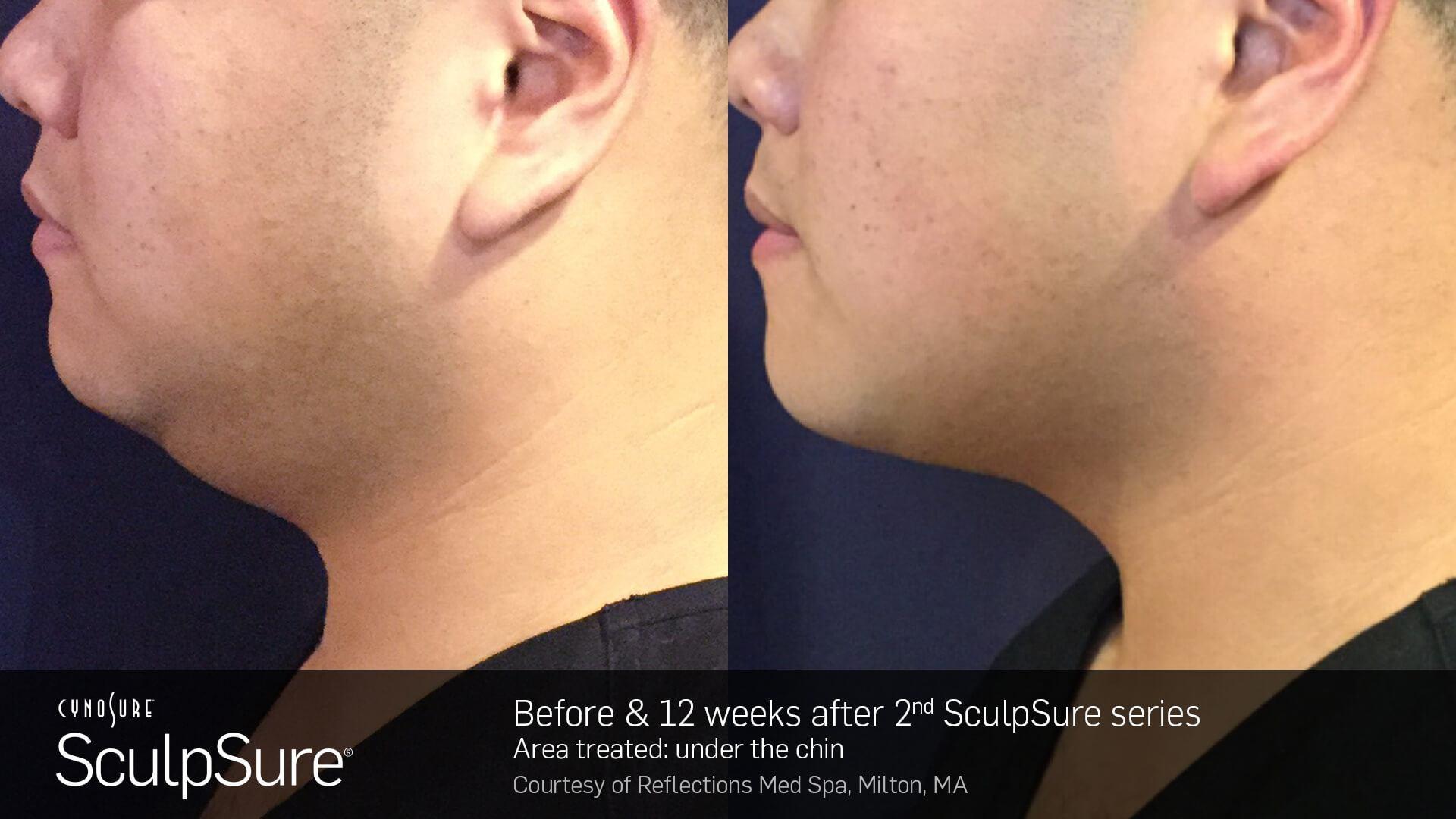 sculpsure before and after chin