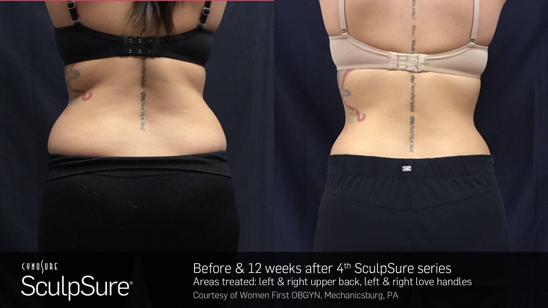 sculpsure before and after flanks