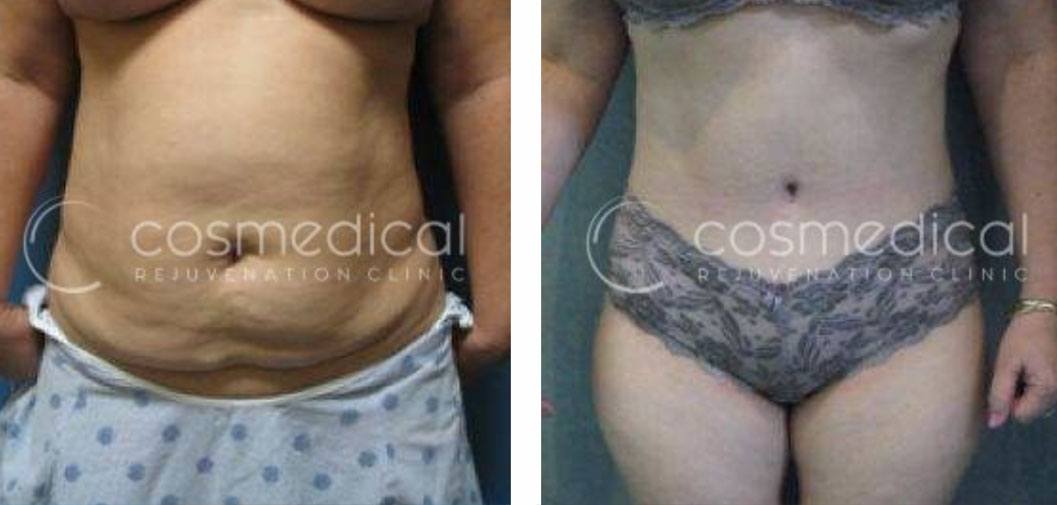 woman with tummy tuck